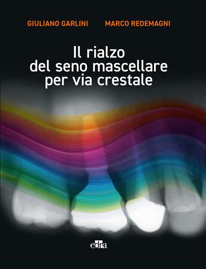 Il rialzo del seno mascellare per via crestale - Giuliano Garlini,Marco Redemagni - copertina