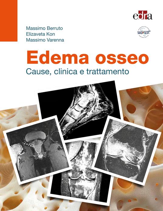 Edema osseo. Cause, clinica e trattamento - Massimo Berruto,Elizaveta Kon,Massimo Varenna - copertina