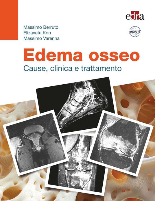 Edema osseo. Cause, clinica e trattamento - Massimo Berruto,Elizaveta Kon,Massimo Varenna - ebook