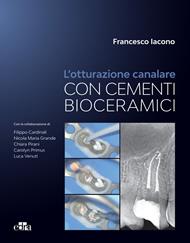 L' otturazione canalare con cementi bioceramici