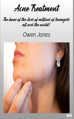 Acne Treatment: How To... - Owen Jones - cover