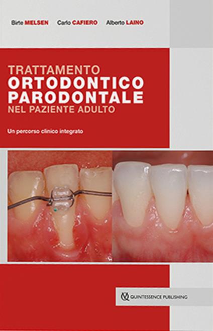 Trattamento ortodontico parodontale nel paziente adulto. Un percorso clinico integrato - Birte Melsen,Carlo Cafiero,Alberto Laino - copertina