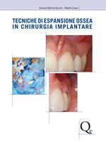 Tecniche di espansione ossea in chirurgia implantare