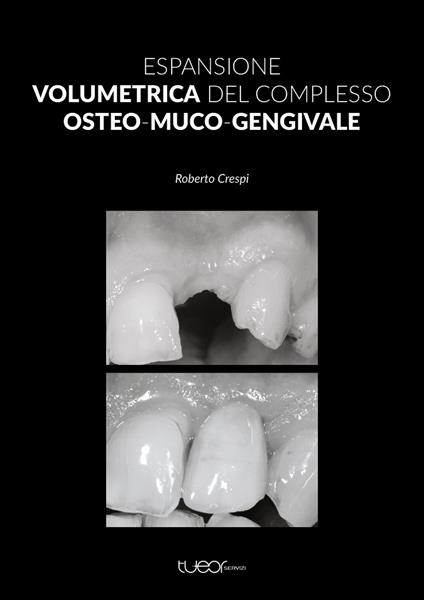 Espansione volumetrica del complesso osteo-muco-gengivale - Roberto Crespi - copertina