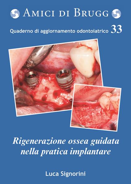 La rigenerazione ossea guidata nella pratica implantare - Luca Signorini - copertina