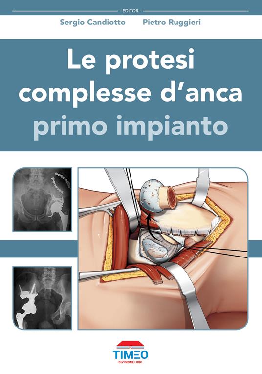 Le protesi complesse d'anca. Primo impianto - Sergio Candiotto,Pietro Ruggieri - copertina