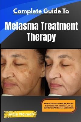 Complete Guide To Melasma Treatment Therapy: Fade Stubborn Dark Patches, Restore Even-Toned Skin, And Build Lasting Confidence With Science-Backed Care - Alaia Nevaeh - cover