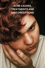Acne causes, treatments and misconceptions