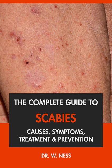 The Complete Guide to Scabies: Causes, Symptoms, Treatment & Prevention