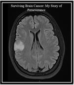 Surviving Brain Cancer: My Story of Perseverance