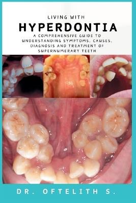 Living with Hyperdontia: A Comprehensive Guide to Understanding Symptoms, Causes, Diagnosis and Treatment of Supernumerary Teeth - Oftelith S - cover