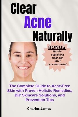 Clear Acne Naturally: The Complete Guide to Acne-Free Skin with Proven Holistic Remedies, DIY Skincare Solutions, and Prevention Tips - Charles James - cover