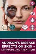 Addison's Disease Effects on Skin - Symptoms and Treatment: Addison's disease is a rare adrenal gland disease that causes various symptoms, including distinct skin effects like hyperpigmentation and vitiligo.
