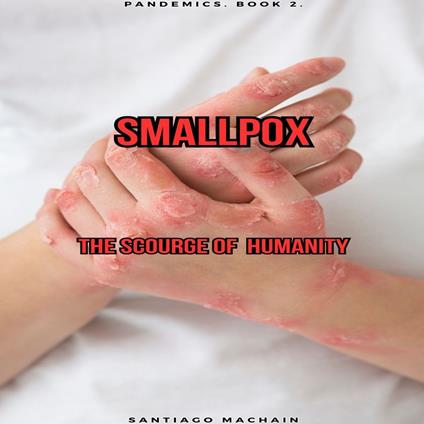 Smallpox